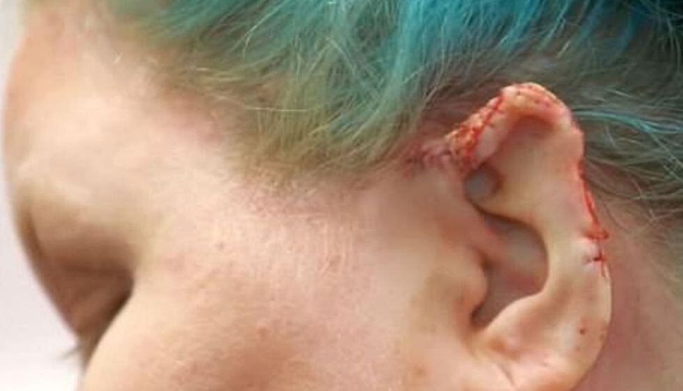 Sus orejas comenzaron a crecer sin control por los piercings que se hizo hace 11 años. Foto: Captura de pantalla de video de The Sun