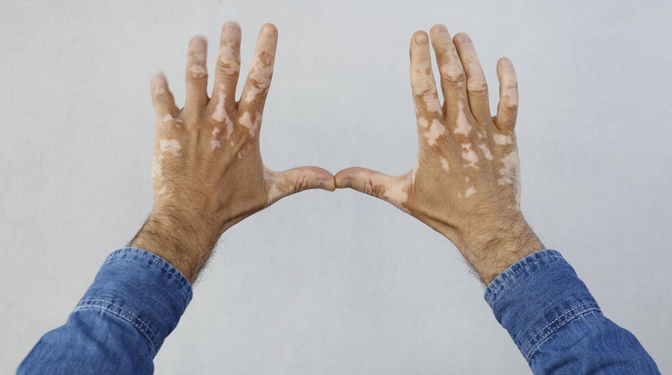 Manchas del vitiligo se dan en varias partes del cuerpo.