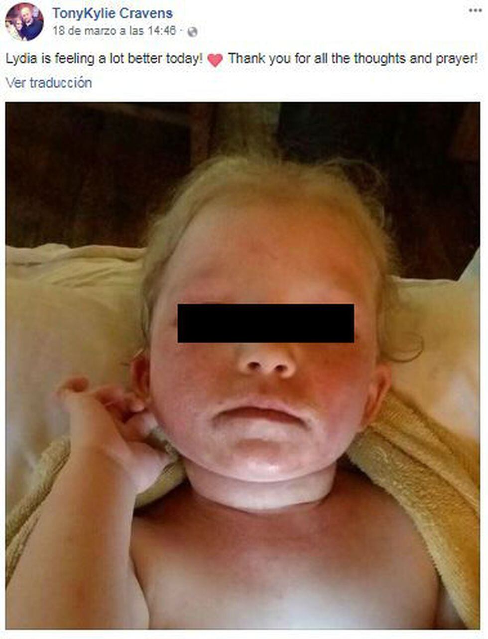 La pequeña recuperándose de las quemaduras del maquillaje. Foto: Facebook