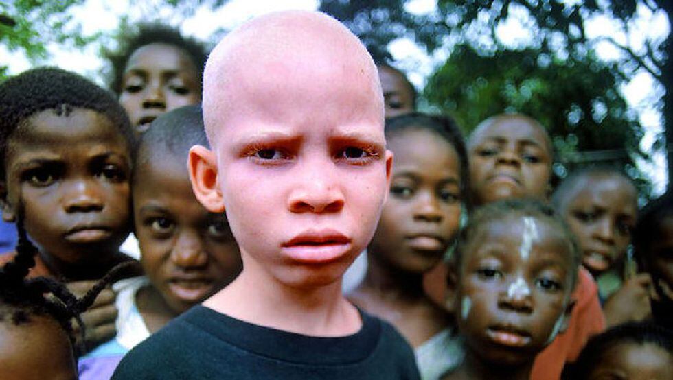 Los albinos también corren riesgos en África.