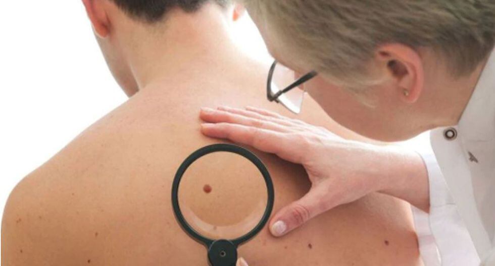 Fue por un lunar y los médicos le dijeron que era cáncer. (Foto referencial: Shutterstock)